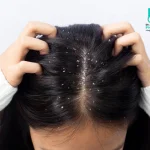 شامپو ضد شوره